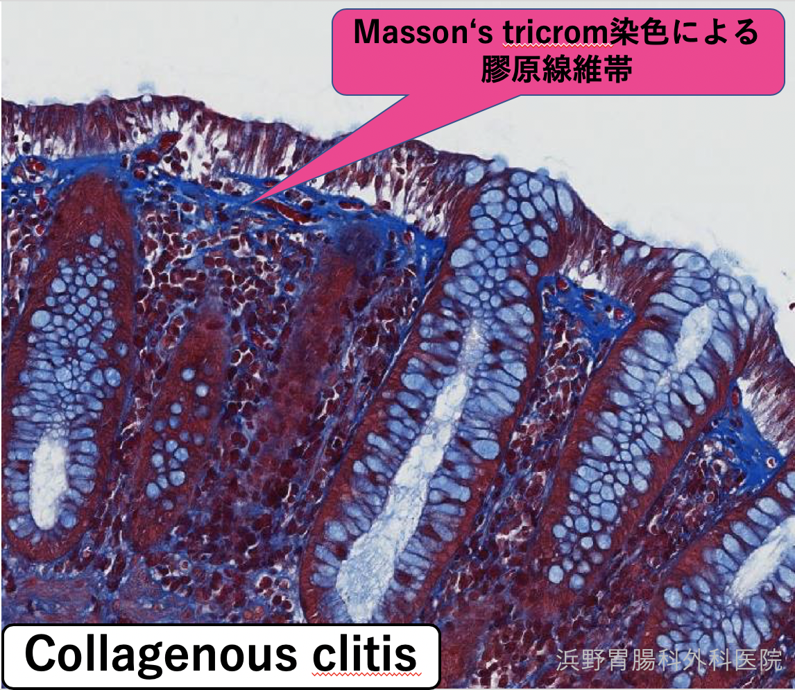 microscopic colitis