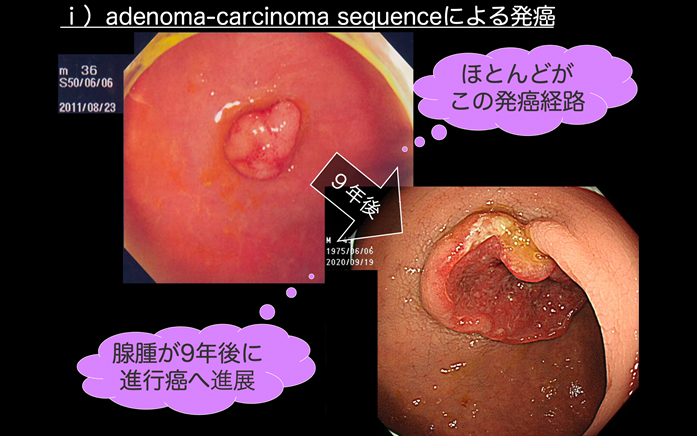 adenoma-carcinoma sequenceによる発癌